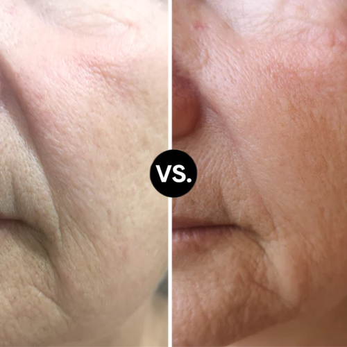 MICRO-INFUSION DART PATCHES